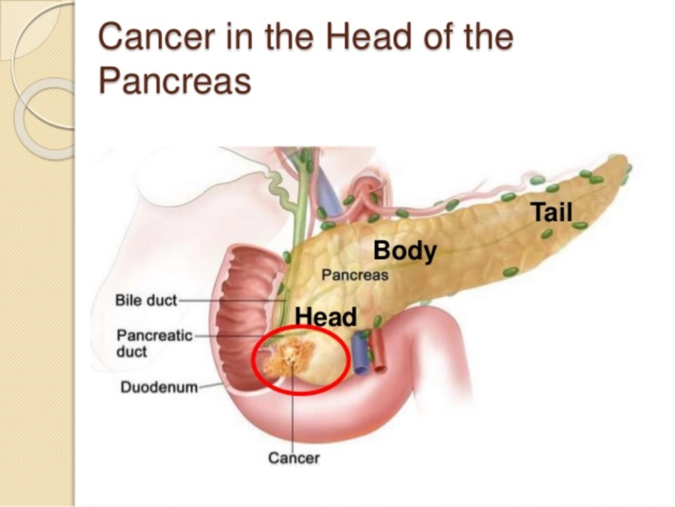 Pancreatic Cancer: Symptoms, Causes, and Risk Factors