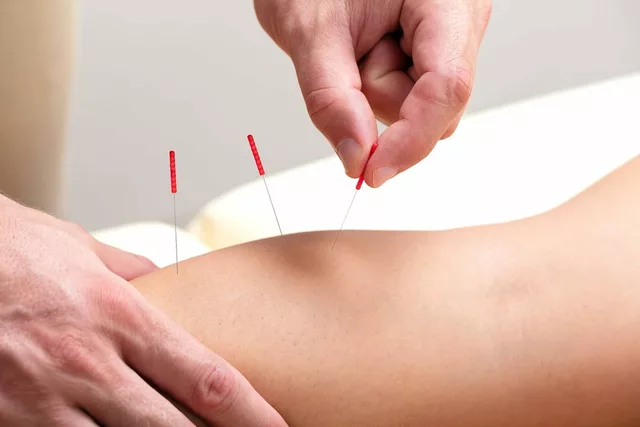 Can Acupuncture Help with Arthritis Pain?